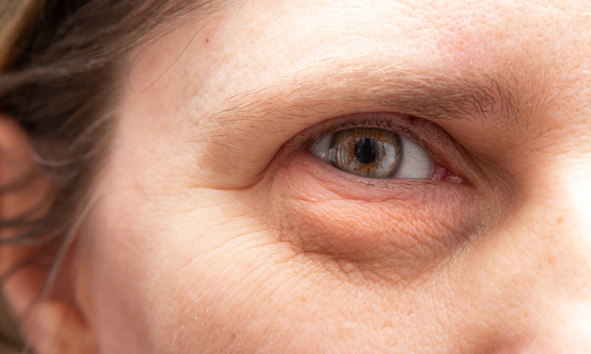 How to Treat Droopy Eyes: Effective Solutions for a More Youthful Look